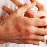Psoriasi, individuato ormone che potrebbe causarla