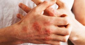 Psoriasi, individuato ormone che potrebbe causarla