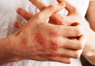 Psoriasi, individuato ormone che potrebbe causarla