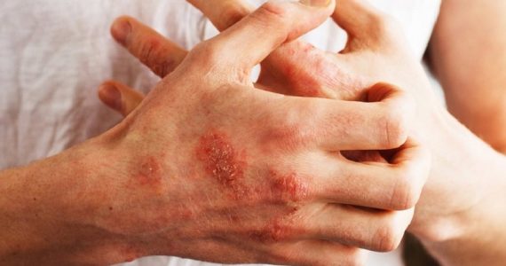 Psoriasi, individuato ormone che potrebbe causarla