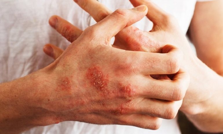 Psoriasi, individuato ormone che potrebbe causarla