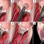 Riparare una seconda volta la valvola mitrale con corde in goretex a cuore battente: alle Molinette di Torino si può