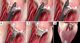 Riparare una seconda volta la valvola mitrale con corde in goretex a cuore battente: alle Molinette di Torino si può