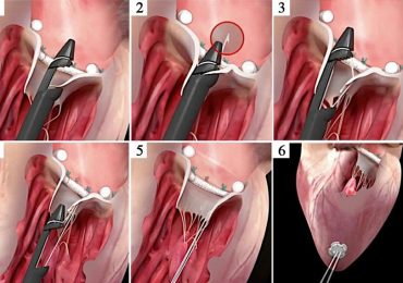 Riparare una seconda volta la valvola mitrale con corde in goretex a cuore battente: alle Molinette di Torino si può