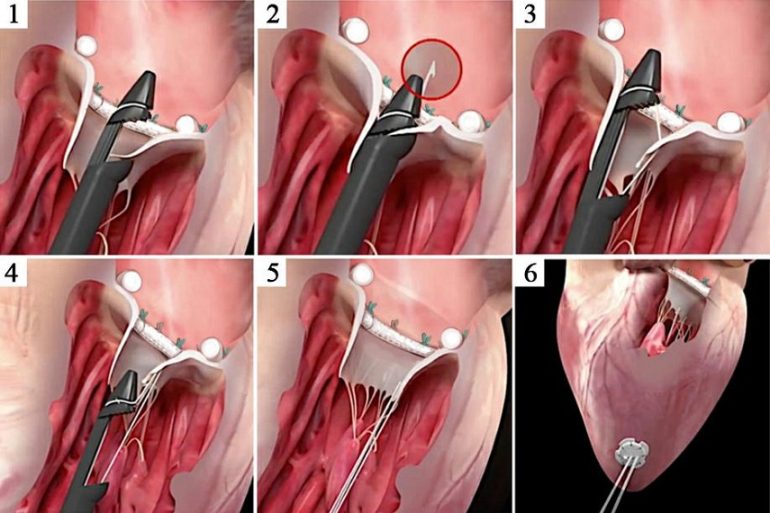 Riparare una seconda volta la valvola mitrale con corde in goretex a cuore battente: alle Molinette di Torino si può