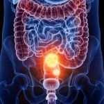 Cancro a colon-retto e prostata: rilavazione più rapida ed economica grazie a nuovo dispositivo portatile