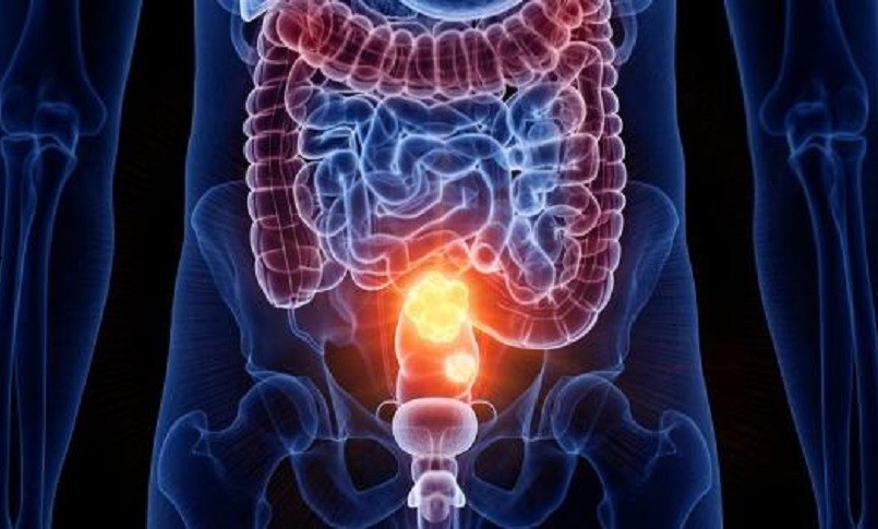 Cancro a colon-retto e prostata: rilavazione più rapida ed economica grazie a nuovo dispositivo portatile