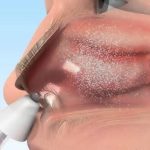 Gestione infermieristica e somministrazione della terapia intranasale tramite MAD© (Mucosal Atomization Device) 2