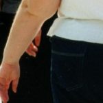 Obesità: possibile svolta con l'arrivo in Italia di tirzepatide