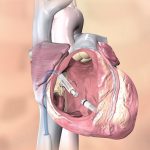 Pacemaker leadless (senza fili): una rivoluzione tecnologica in cardiologia