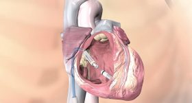 Pacemaker leadless (senza fili): una rivoluzione tecnologica in cardiologia