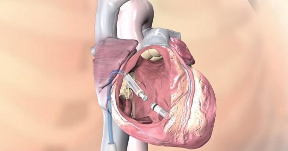 Pacemaker leadless (senza fili): una rivoluzione tecnologica in cardiologia