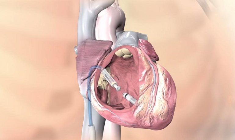 Pacemaker leadless (senza fili): una rivoluzione tecnologica in cardiologia